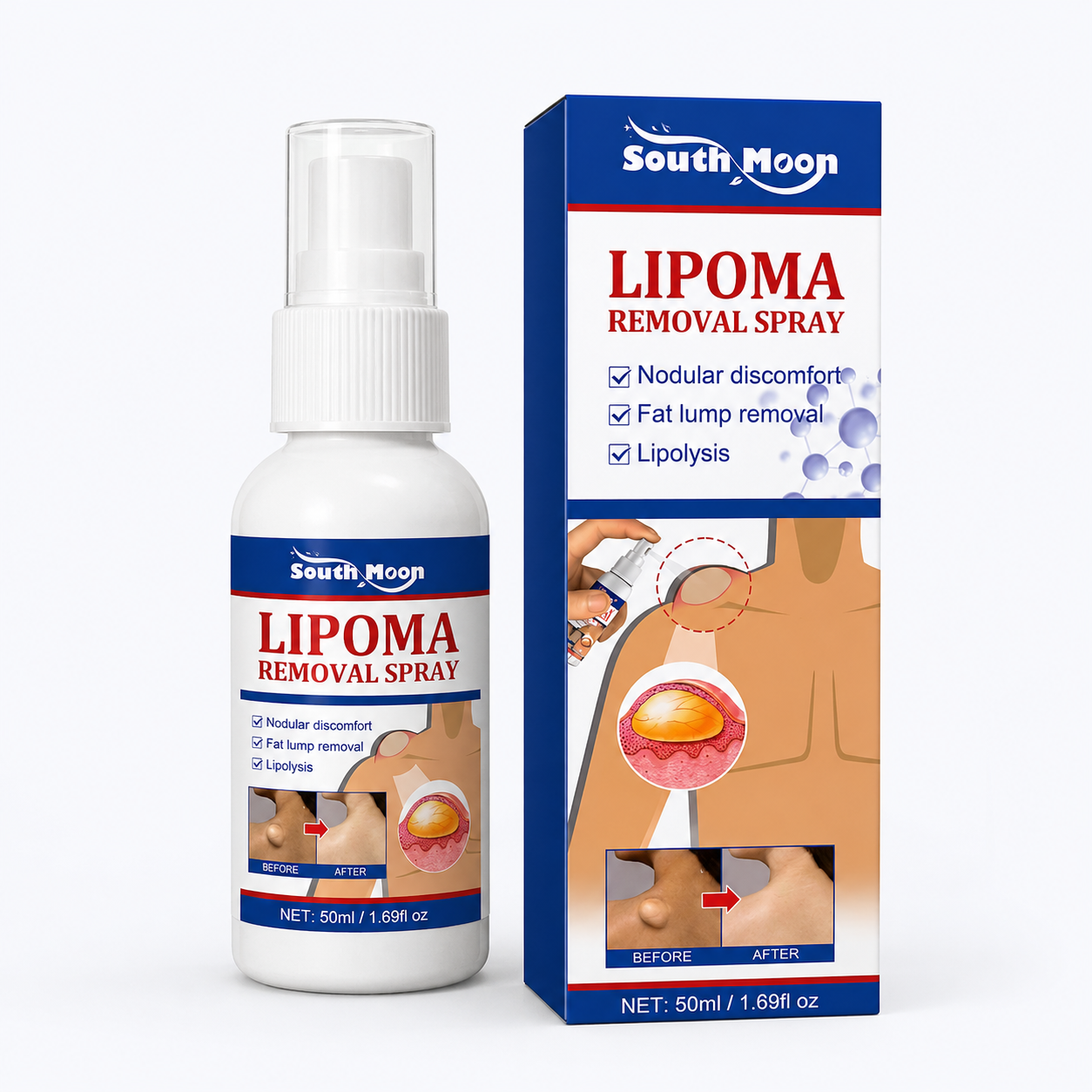 South Moon Lipoma Removal Spray – Topical Body Care Spray, 50ml